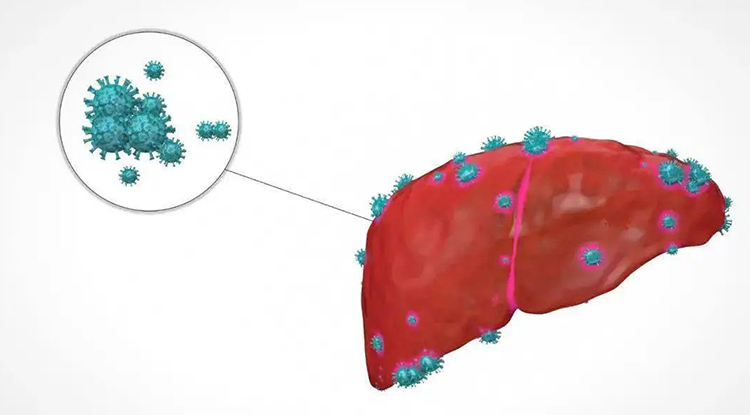 肝硬化的病因有哪些？