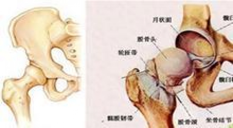 股骨头坏死的前兆