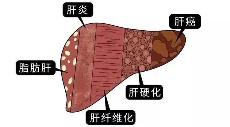 肝硬化在代偿期、失代偿期各自有何症状？